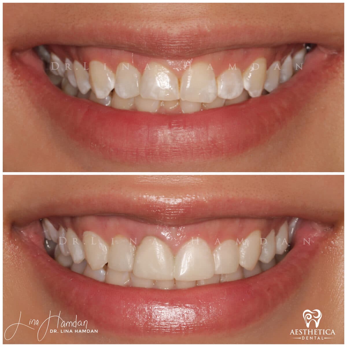 Composite bonding.: anonymous before-and-after case photograph from Aesthetica Dental Naperville