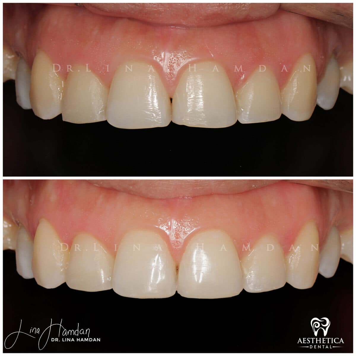 Composite bonding: anonymous case 14 from Aesthetica Dental Naperville
