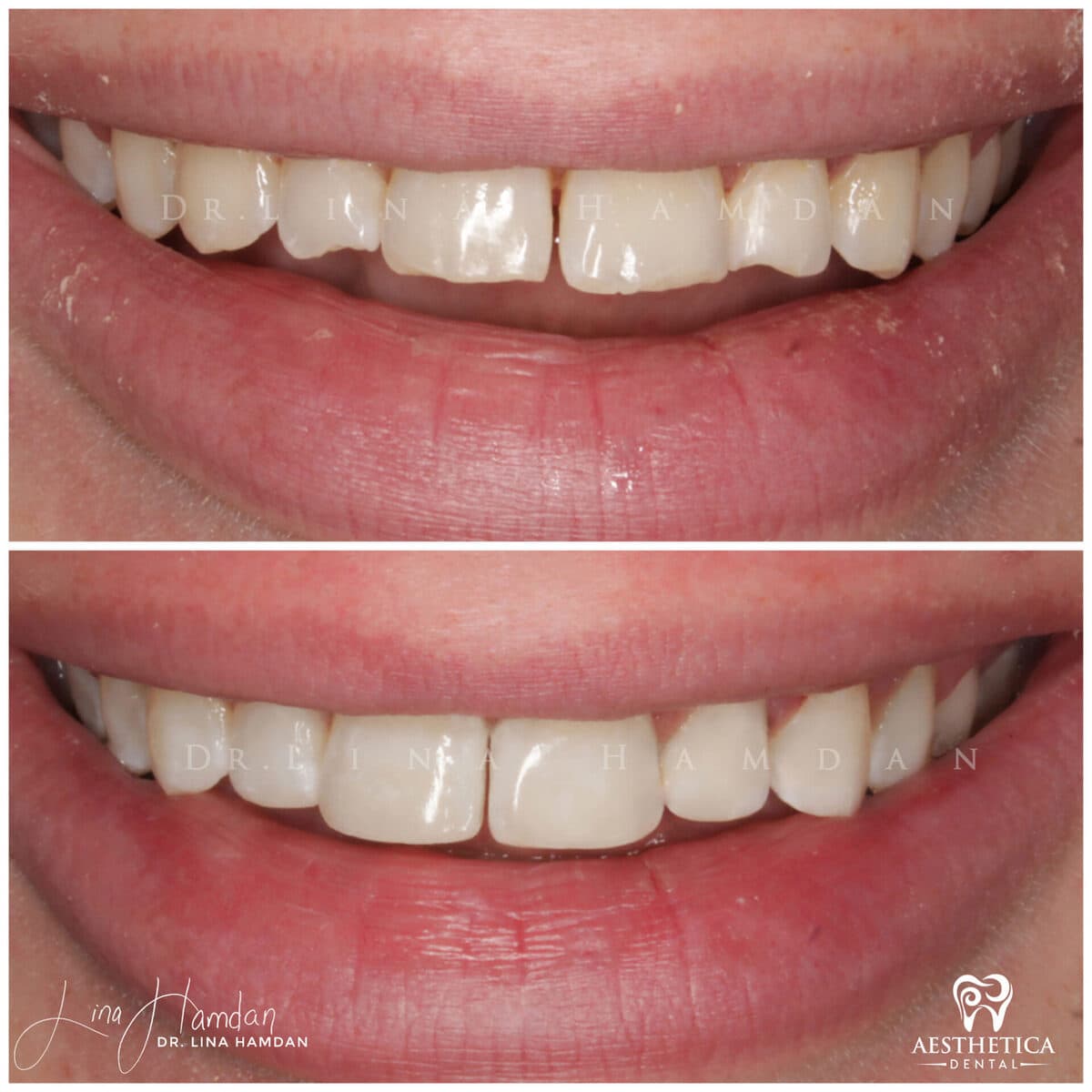 Composite bonding: anonymous case 16 from Aesthetica Dental Naperville