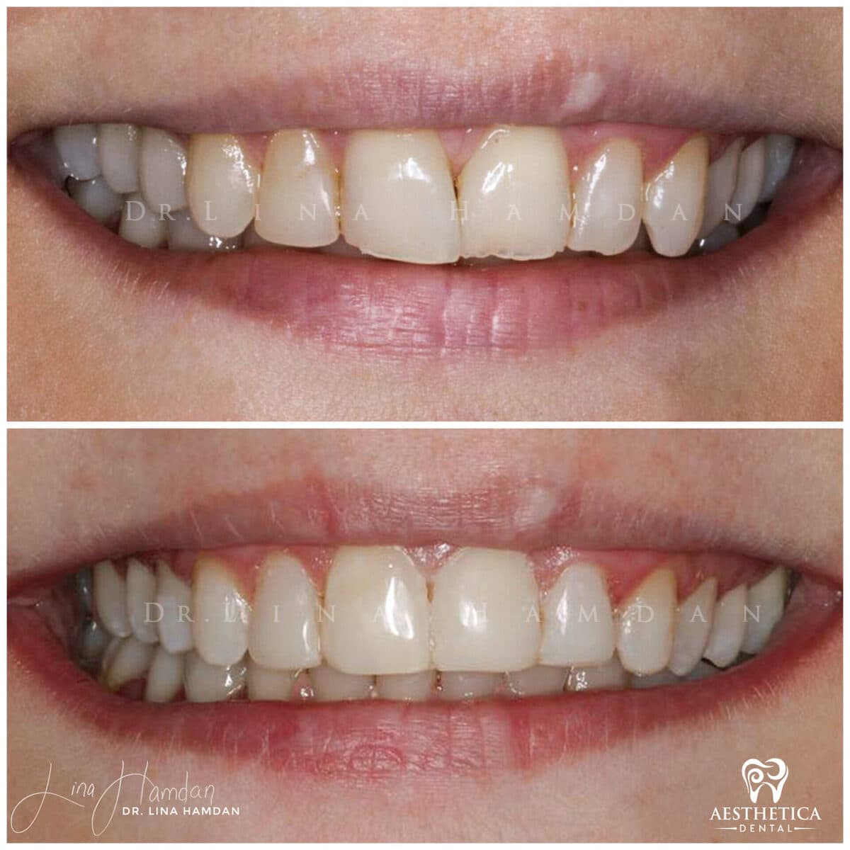 Composite bonding: anonymous case 17 from Aesthetica Dental Naperville