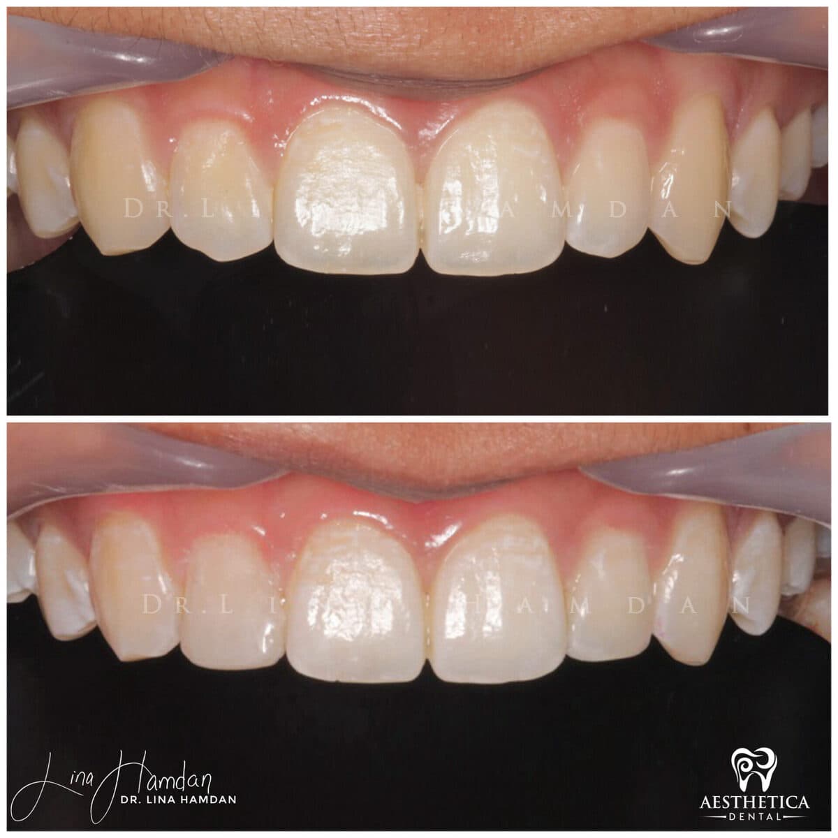 Composite bonding: anonymous case 18 from Aesthetica Dental Naperville