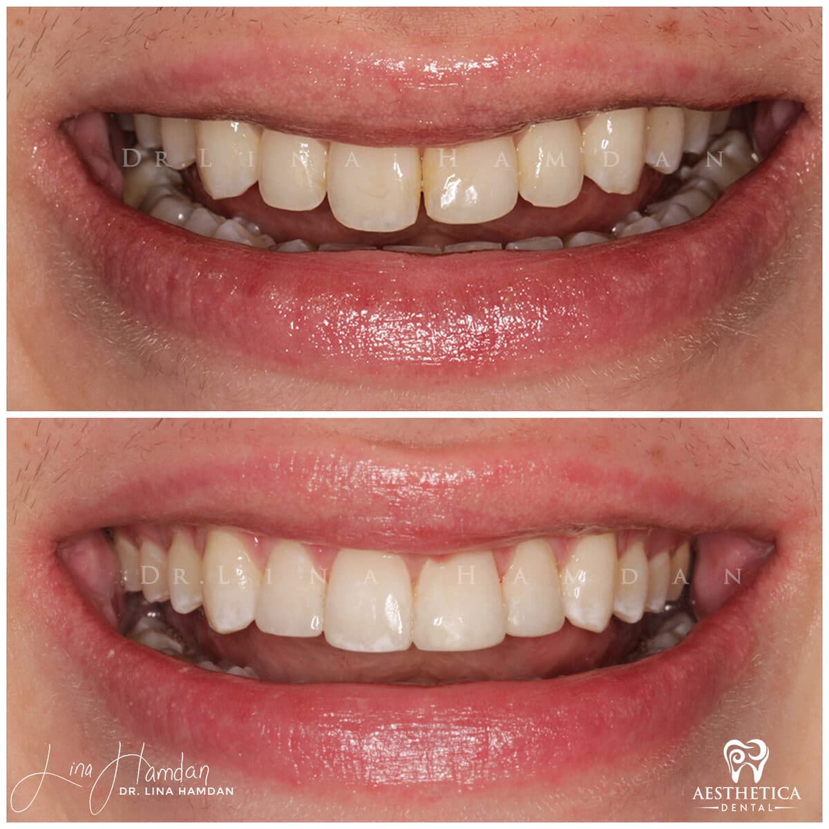 Composite bonding: anonymous case 19 from Aesthetica Dental Naperville