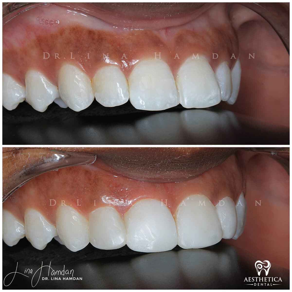 Composite bonding: anonymous case 21 from Aesthetica Dental Naperville