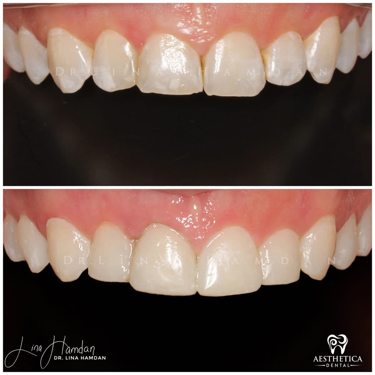 Composite bonding: anonymous case 23 from Aesthetica Dental Naperville