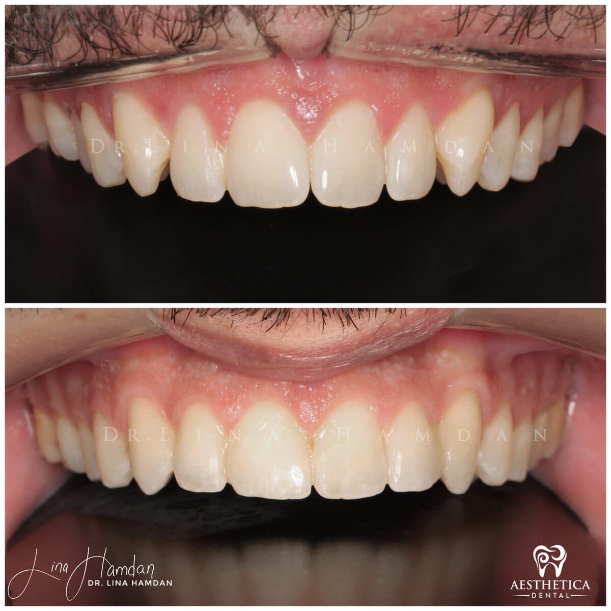 Composite bonding: anonymous case 24 from Aesthetica Dental Naperville