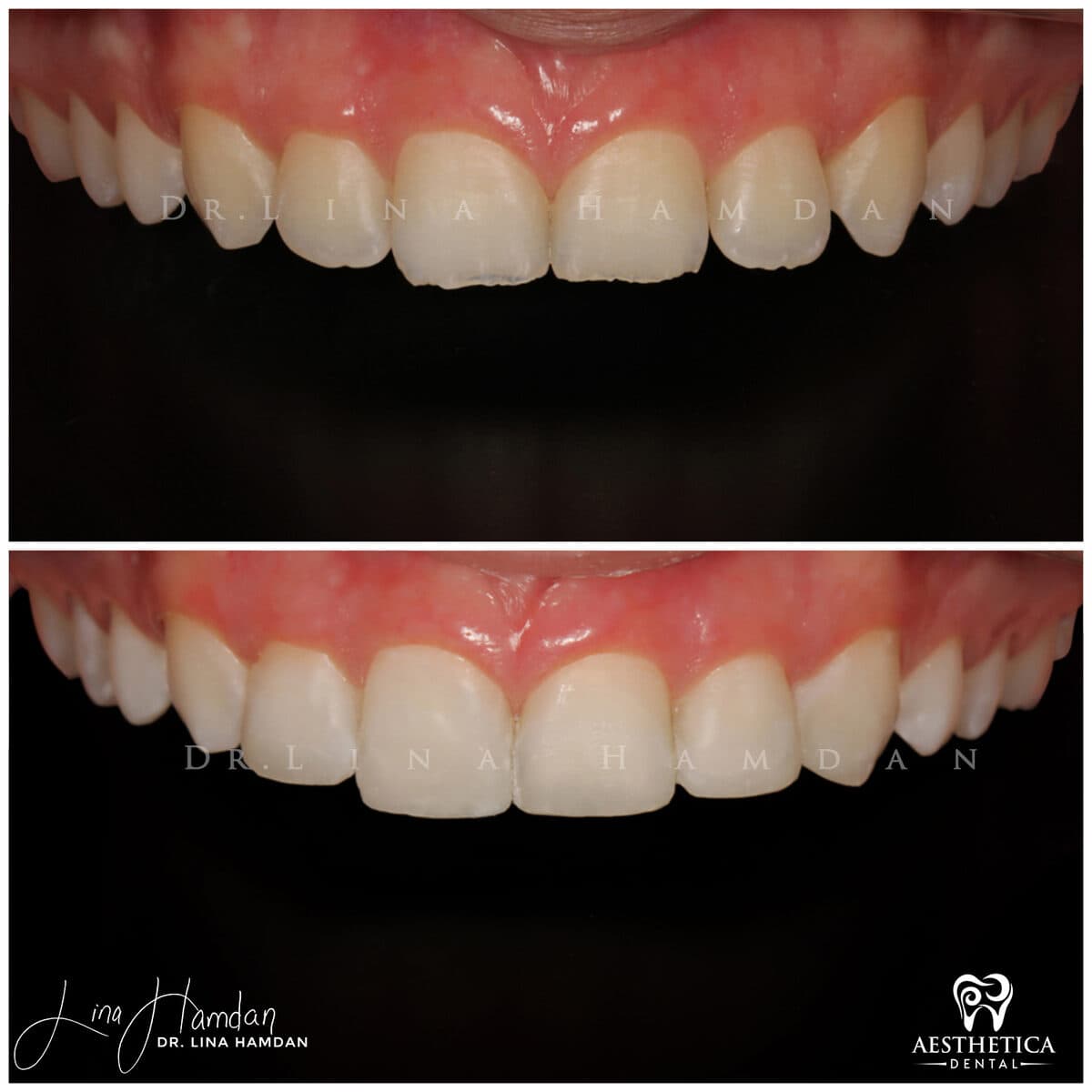 Composite bonding: anonymous case 26 from Aesthetica Dental Naperville