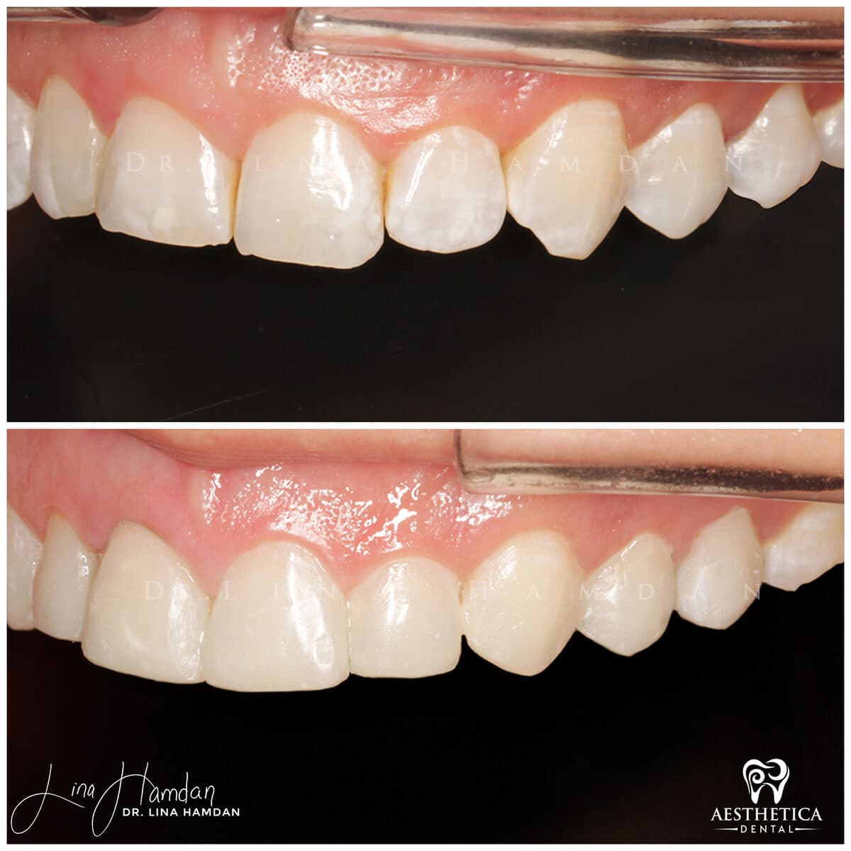 Composite bonding: anonymous case 27 from Aesthetica Dental Naperville