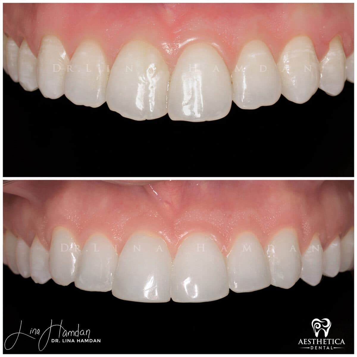 Composite bonding: anonymous case 30 from Aesthetica Dental Naperville