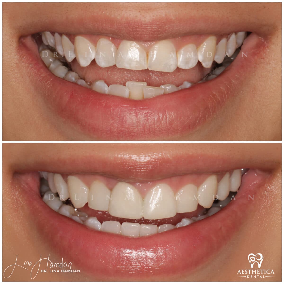 Composite bonding: anonymous case 32 from Aesthetica Dental Naperville