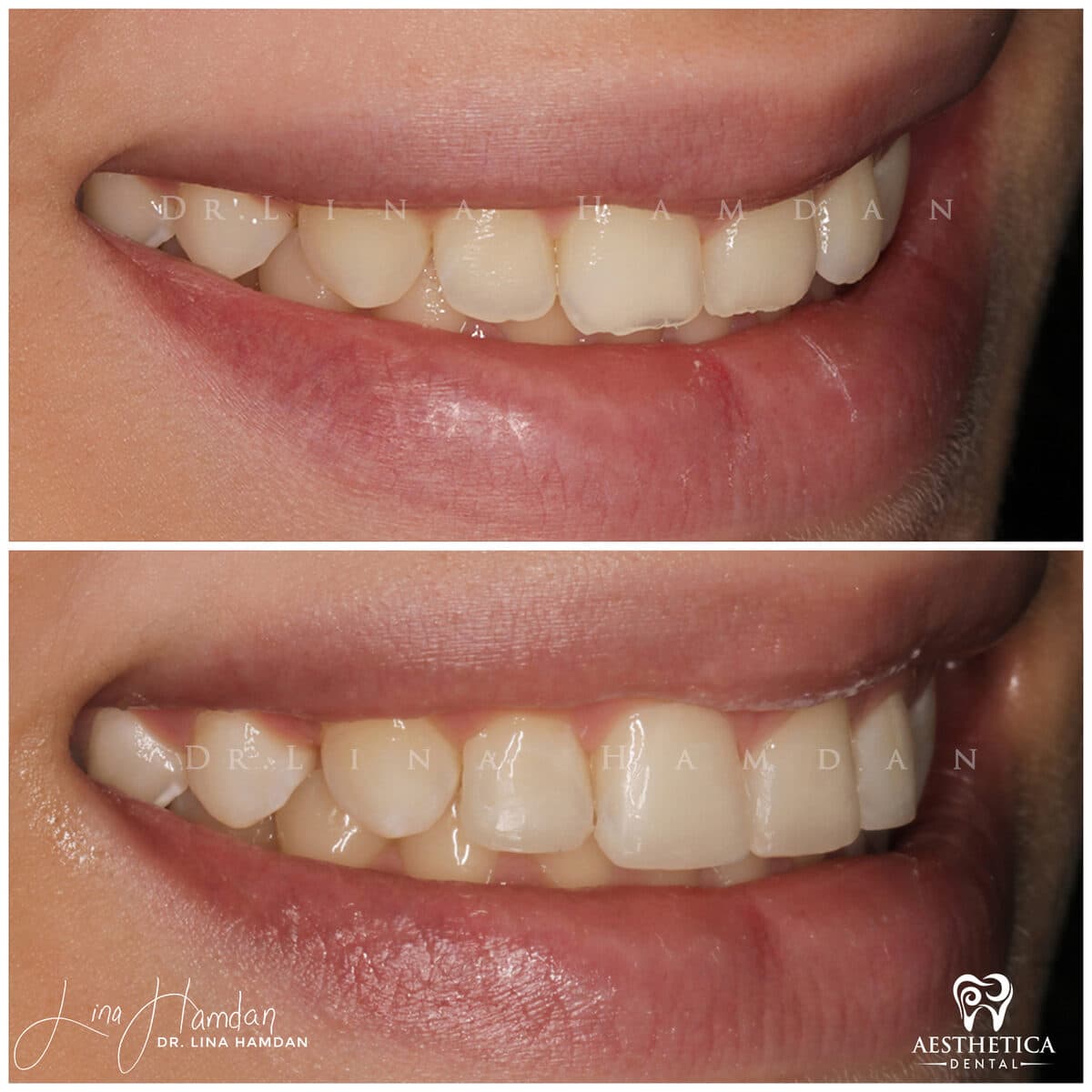 Composite bonding: anonymous case 33 from Aesthetica Dental Naperville