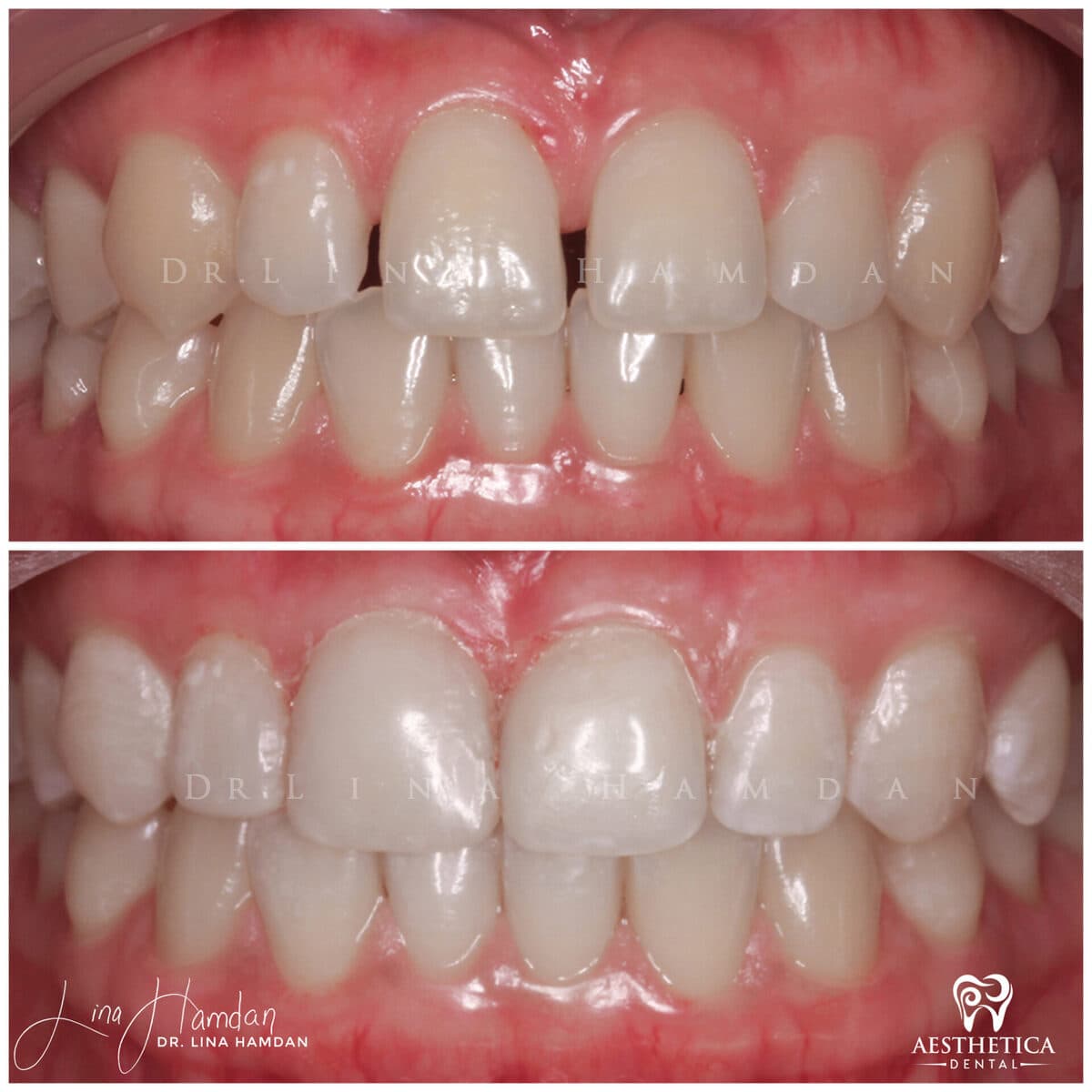 Composite bonding: anonymous case 34 from Aesthetica Dental Naperville