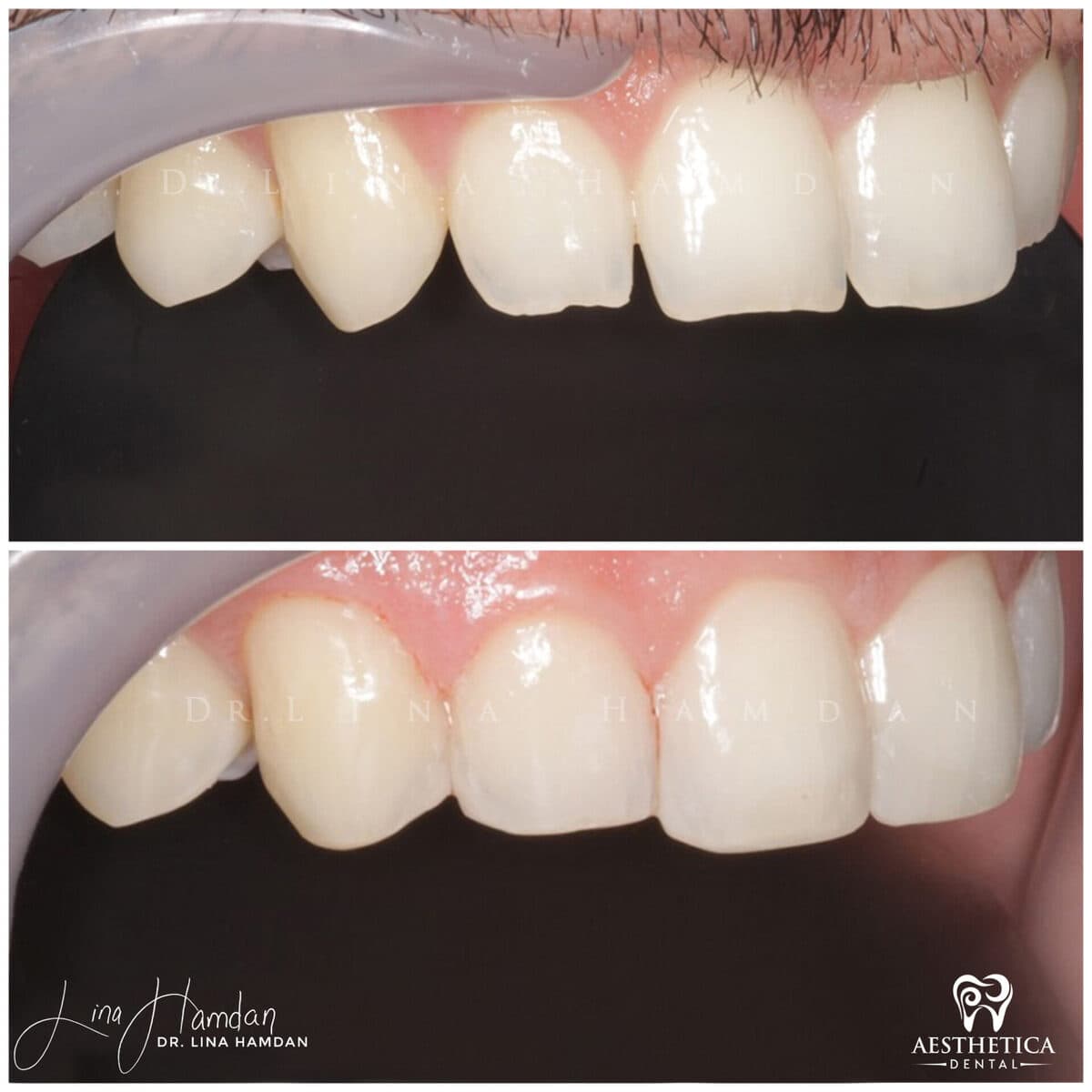 Composite bonding: anonymous case 35 from Aesthetica Dental Naperville