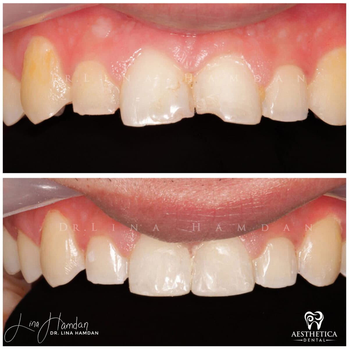 Composite bonding: anonymous case 37 from Aesthetica Dental Naperville