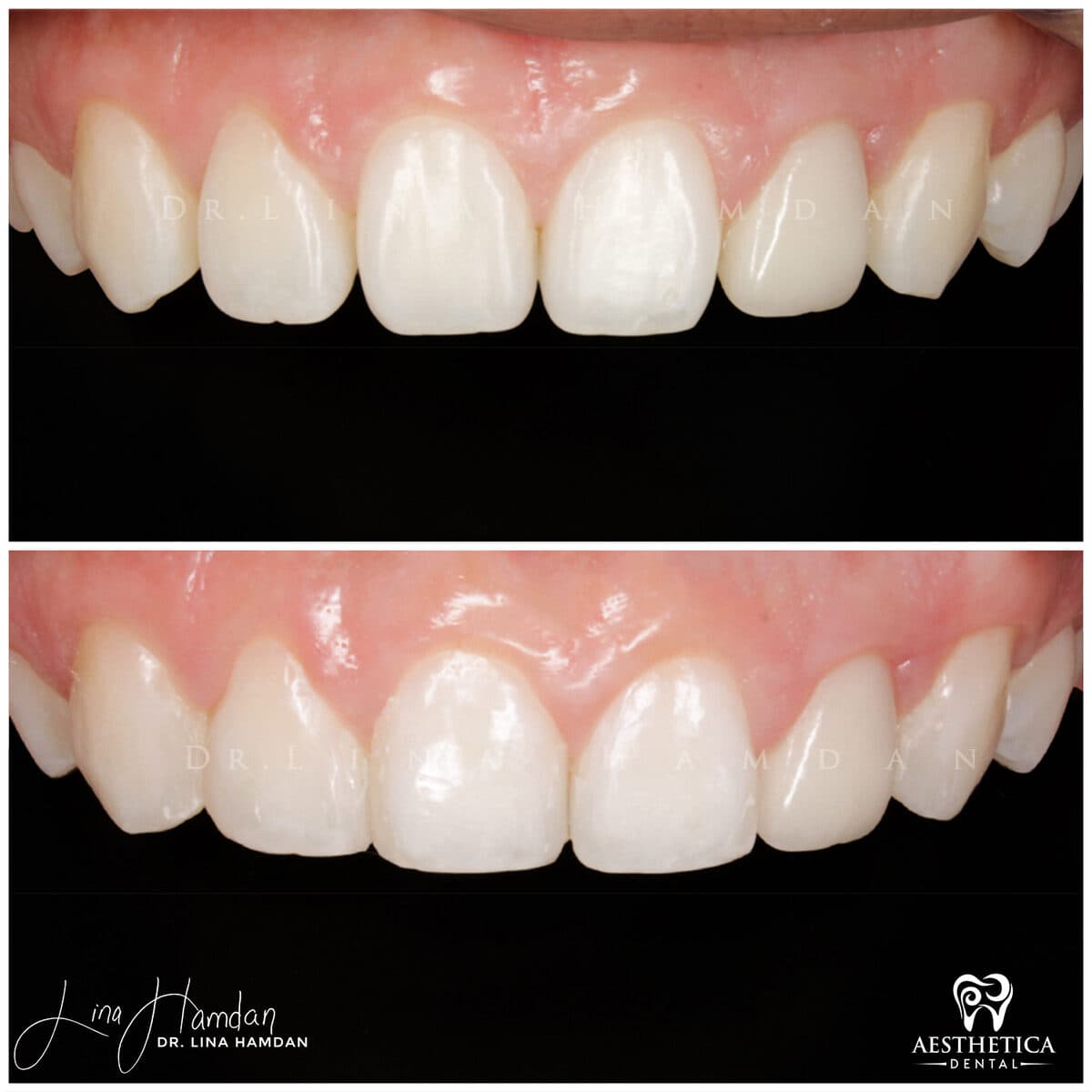 Composite bonding: anonymous case 39 from Aesthetica Dental Naperville