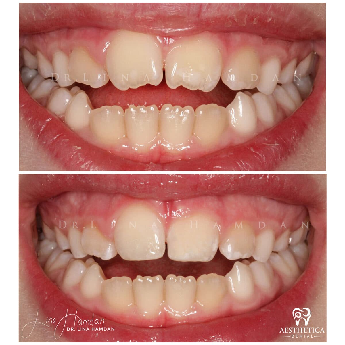 Composite bonding: anonymous case 40 from Aesthetica Dental Naperville