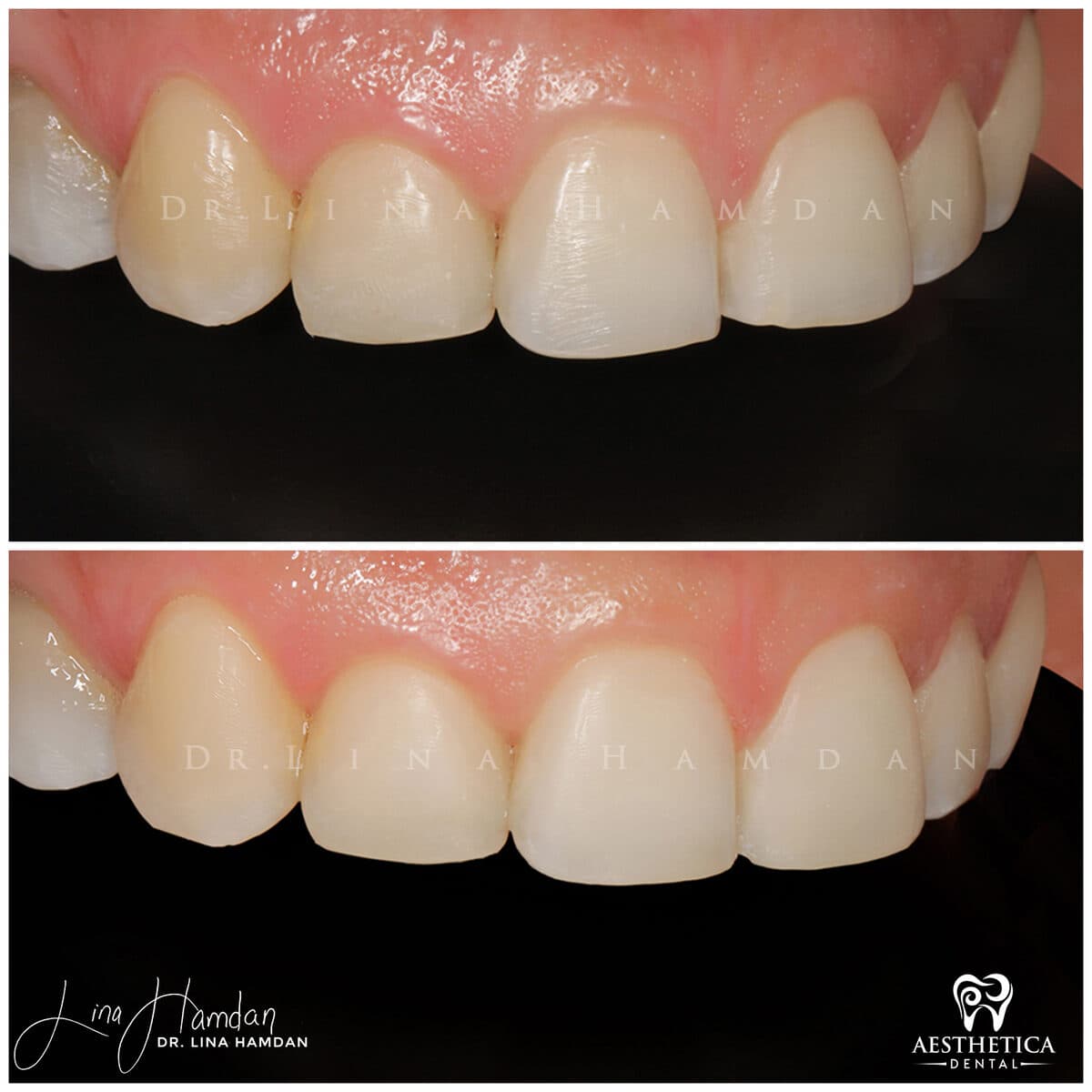 Composite bonding: anonymous case 41 from Aesthetica Dental Naperville