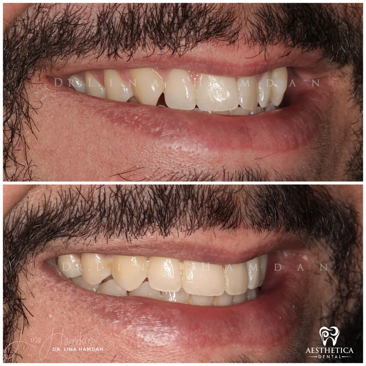Composite bonding: anonymous case 42 from Aesthetica Dental Naperville