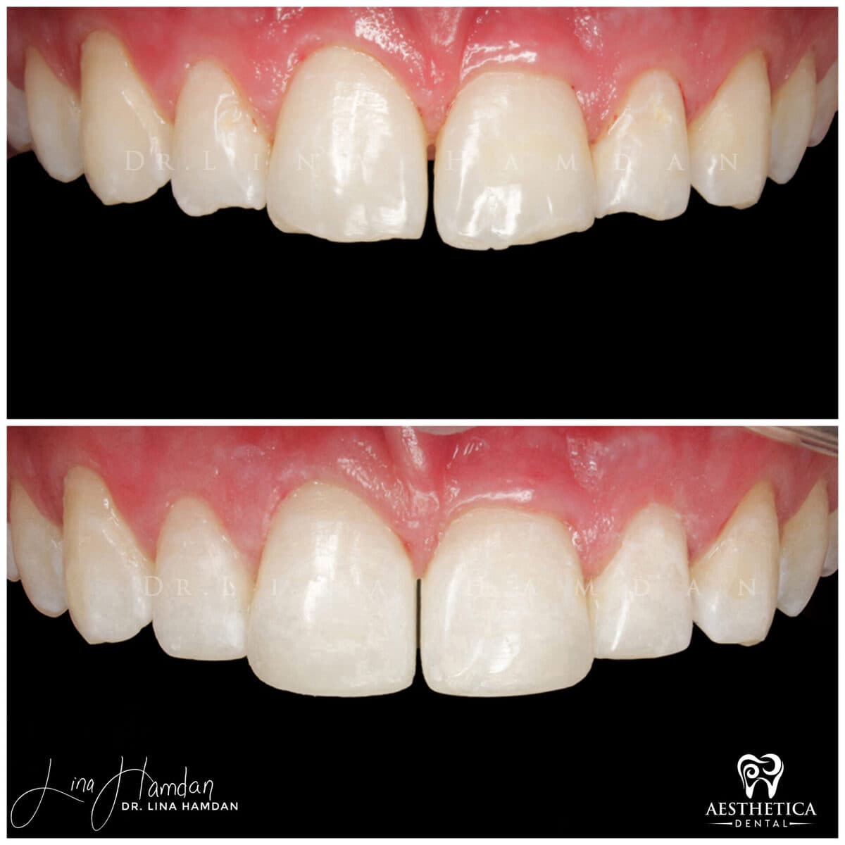 Composite bonding: anonymous case 43 from Aesthetica Dental Naperville