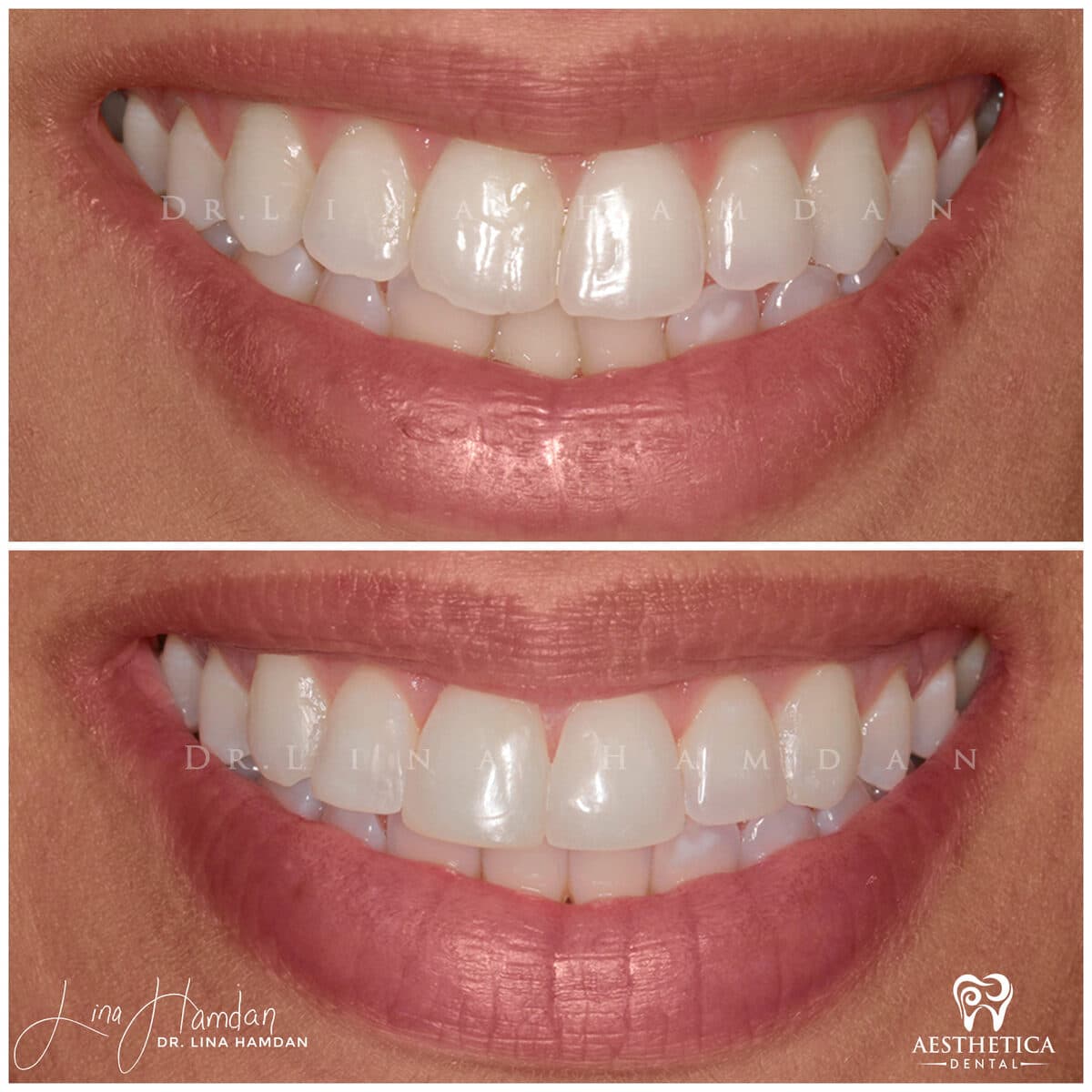 Composite bonding: anonymous case 44 from Aesthetica Dental Naperville