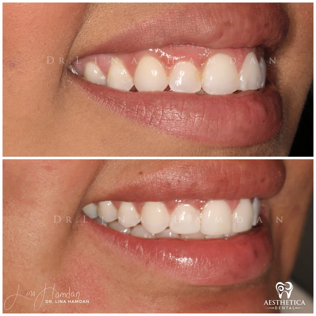 Composite bonding: anonymous case 46 from Aesthetica Dental Naperville