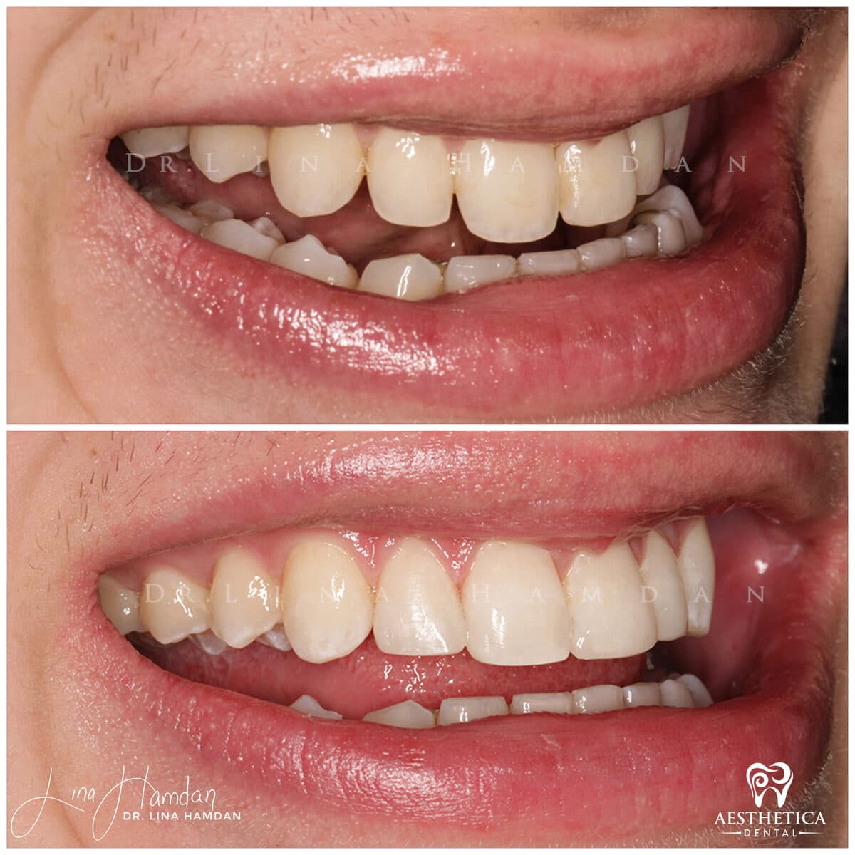 Composite bonding: anonymous case 47 from Aesthetica Dental Naperville