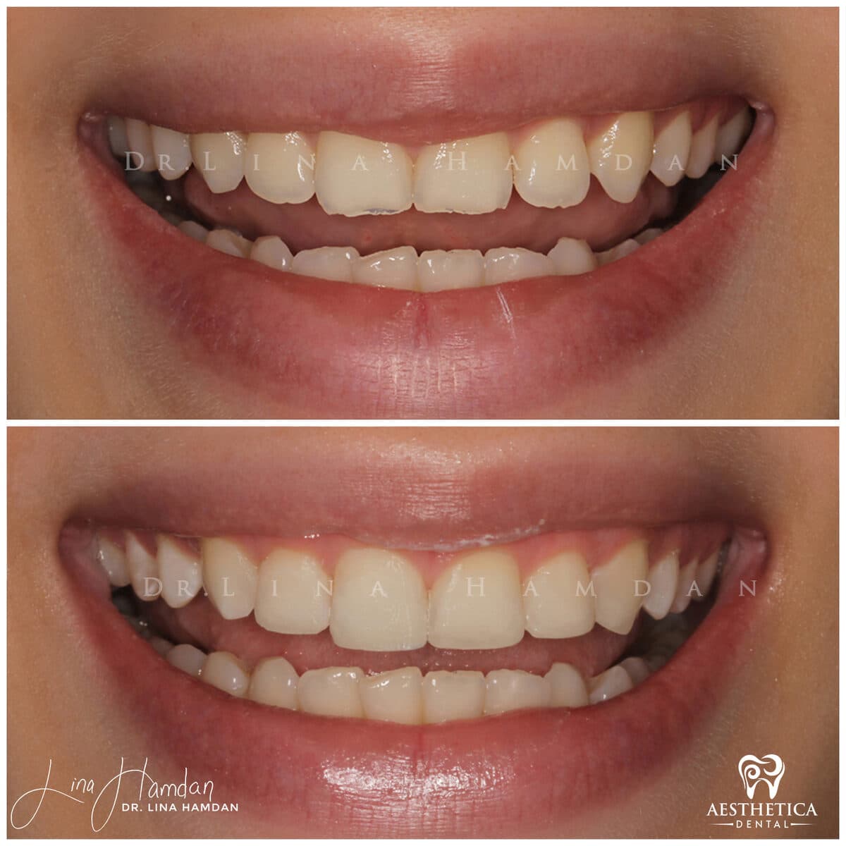 Composite bonding: anonymous case 48 from Aesthetica Dental Naperville