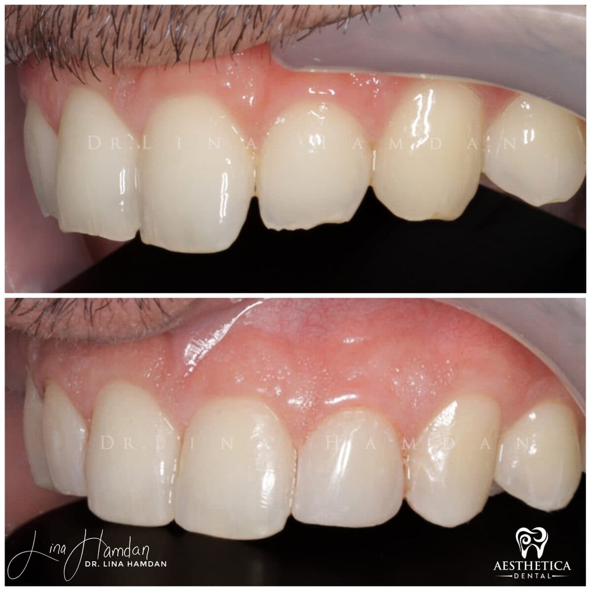 Composite bonding: anonymous case 49 from Aesthetica Dental Naperville