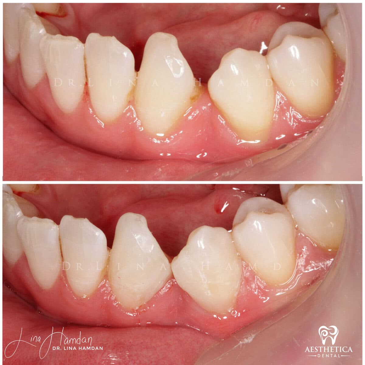 Composite bonding: anonymous case 51 from Aesthetica Dental Naperville