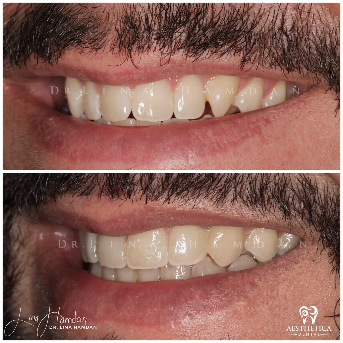 Composite bonding: anonymous case 55 from Aesthetica Dental Naperville