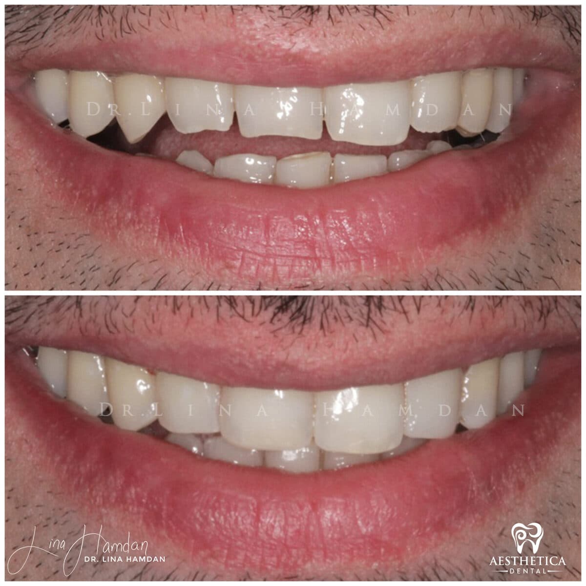 Composite bonding: anonymous case 56 from Aesthetica Dental Naperville