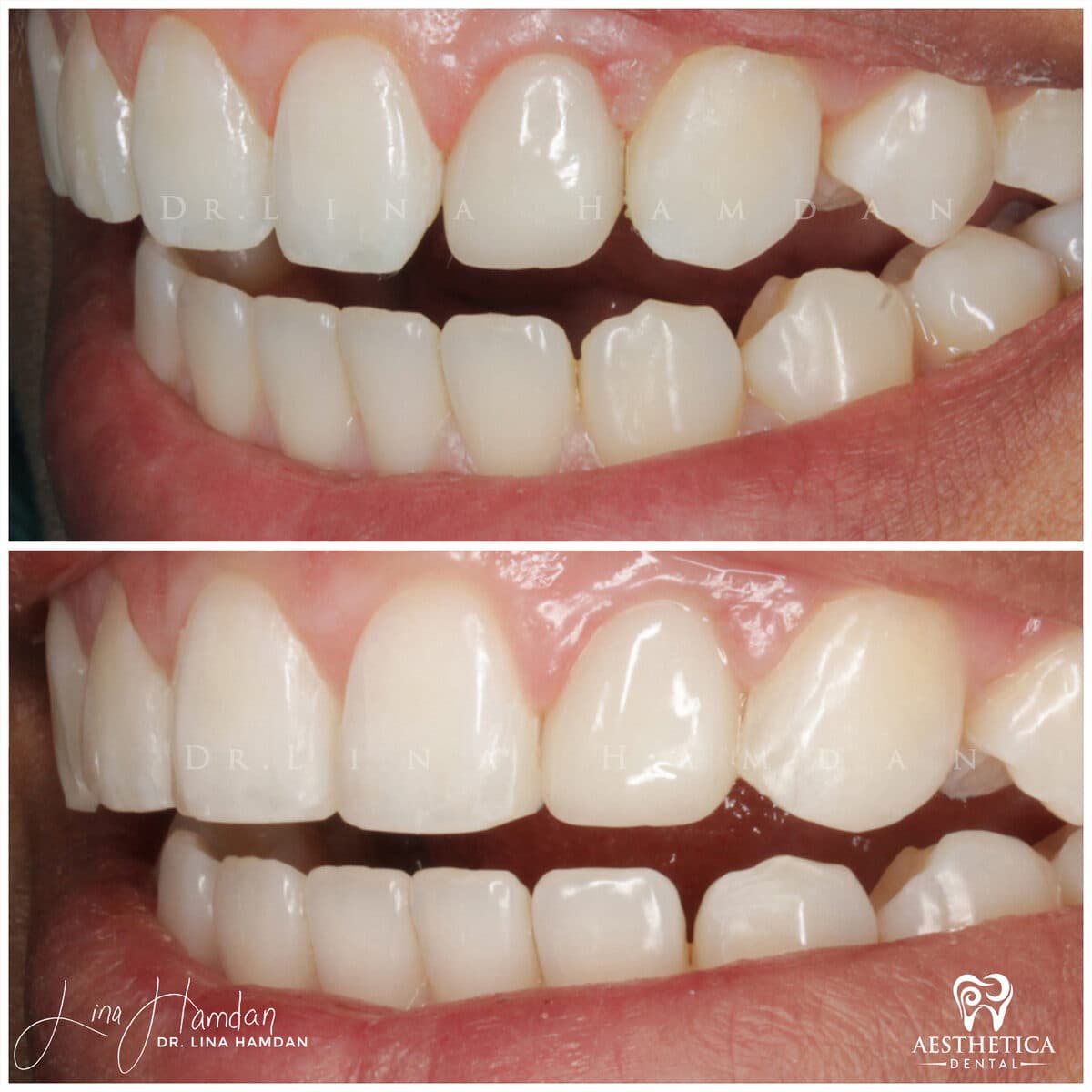 Composite bonding: anonymous case 58 from Aesthetica Dental Naperville