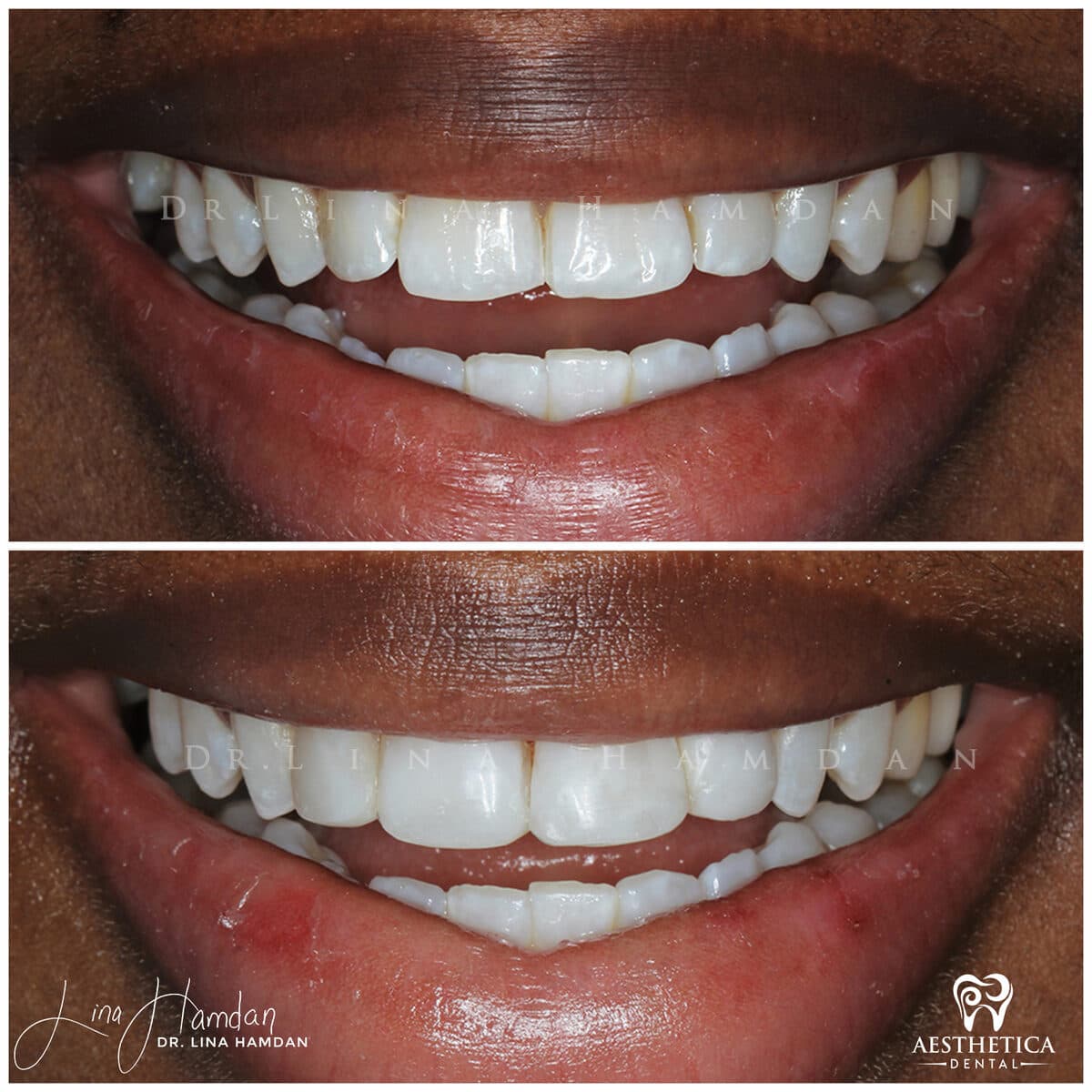 Composite bonding: anonymous case 59 from Aesthetica Dental Naperville