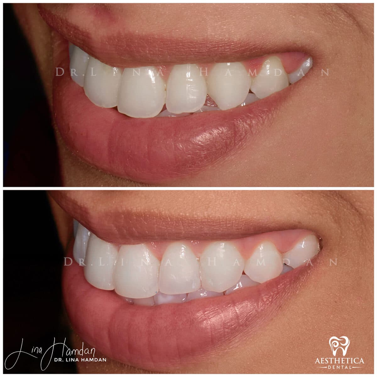 Composite bonding: anonymous case 61 from Aesthetica Dental Naperville