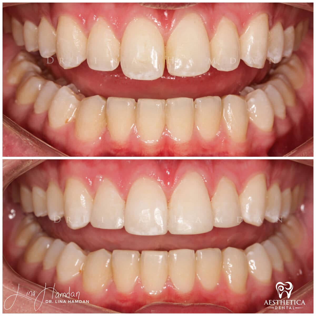 Composite bonding: anonymous case 62 from Aesthetica Dental Naperville