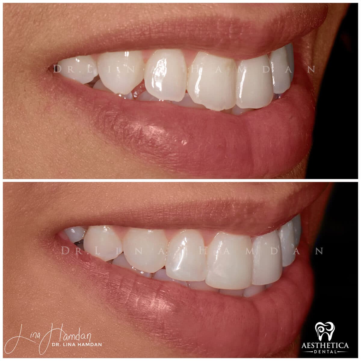 Composite bonding: anonymous case 63 from Aesthetica Dental Naperville