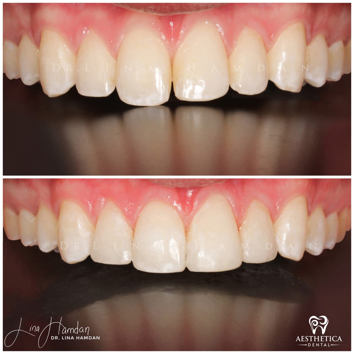 Composite bonding: anonymous case 67 from Aesthetica Dental Naperville