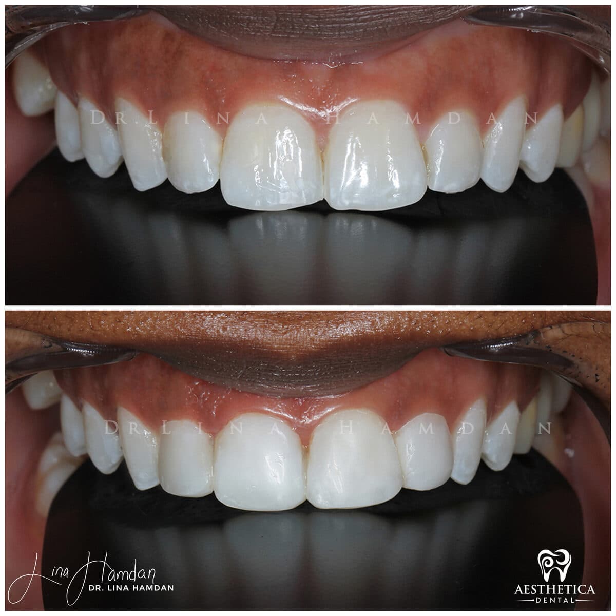 Composite bonding: anonymous case 68 from Aesthetica Dental Naperville