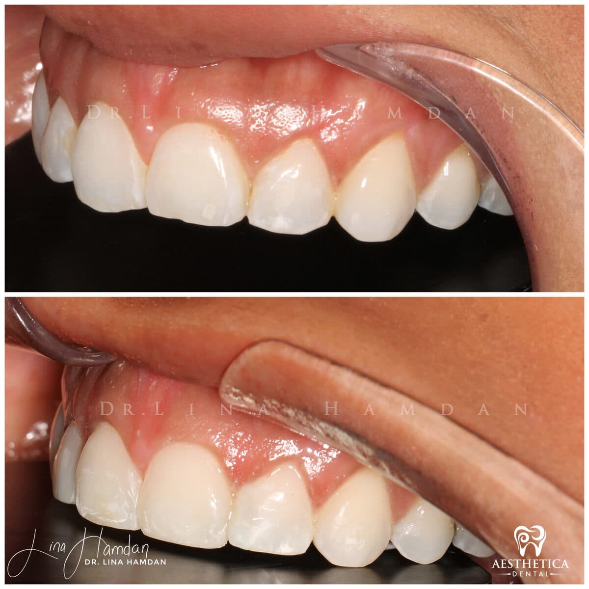 Composite bonding: anonymous case 69 from Aesthetica Dental Naperville
