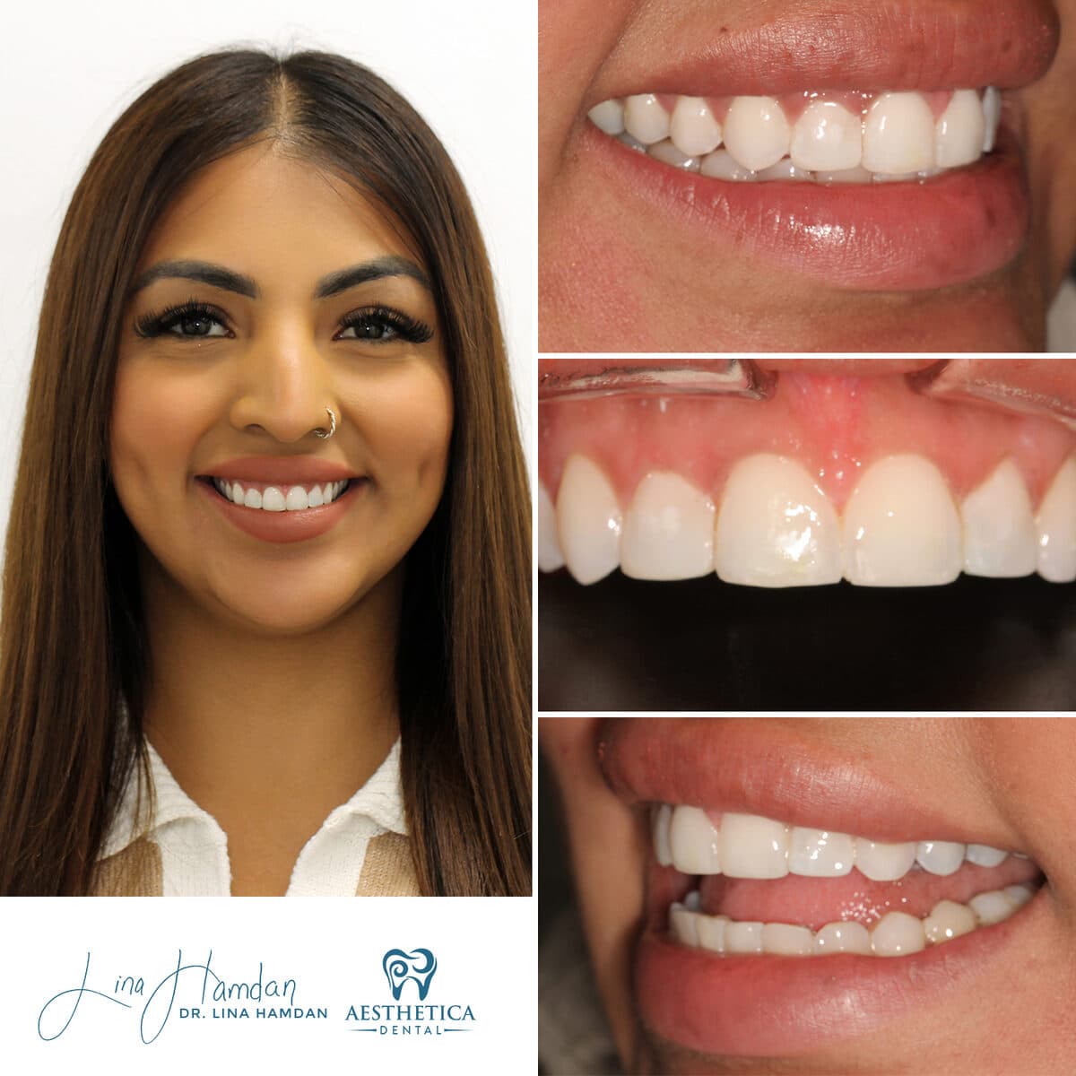 Composite bonding: anonymous case 70 from Aesthetica Dental Naperville