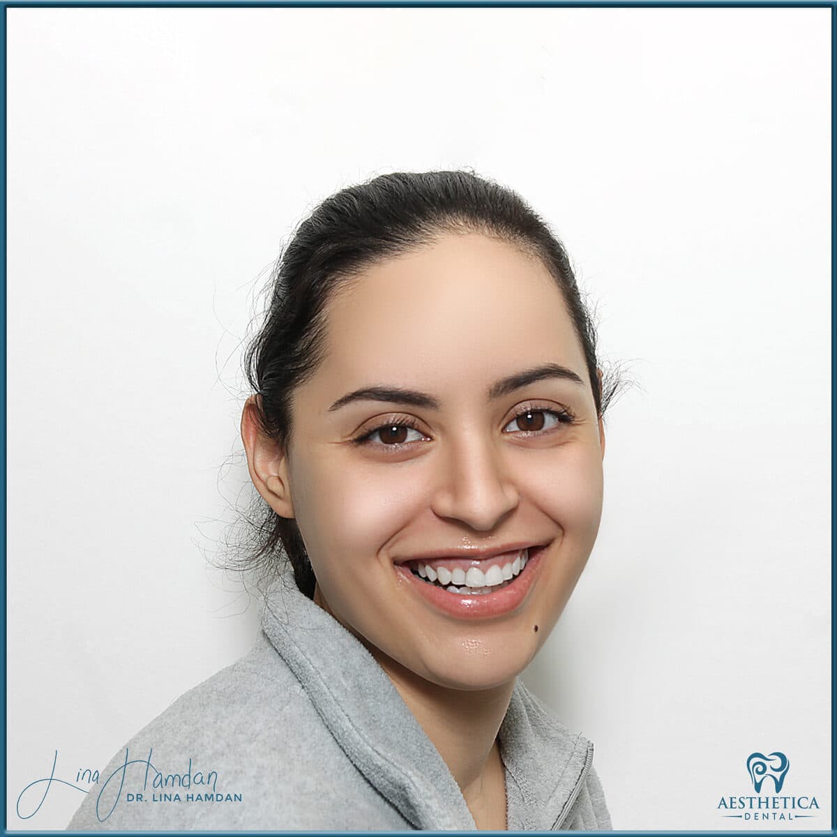 Composite bonding: anonymous case 71 from Aesthetica Dental Naperville
