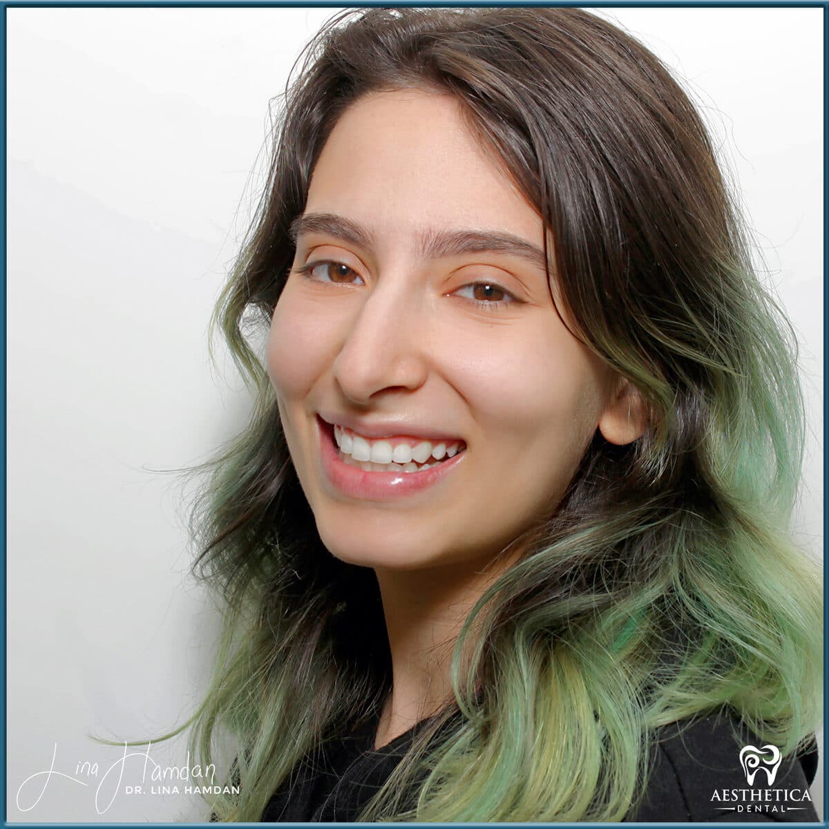 Composite bonding: anonymous case 72 from Aesthetica Dental Naperville