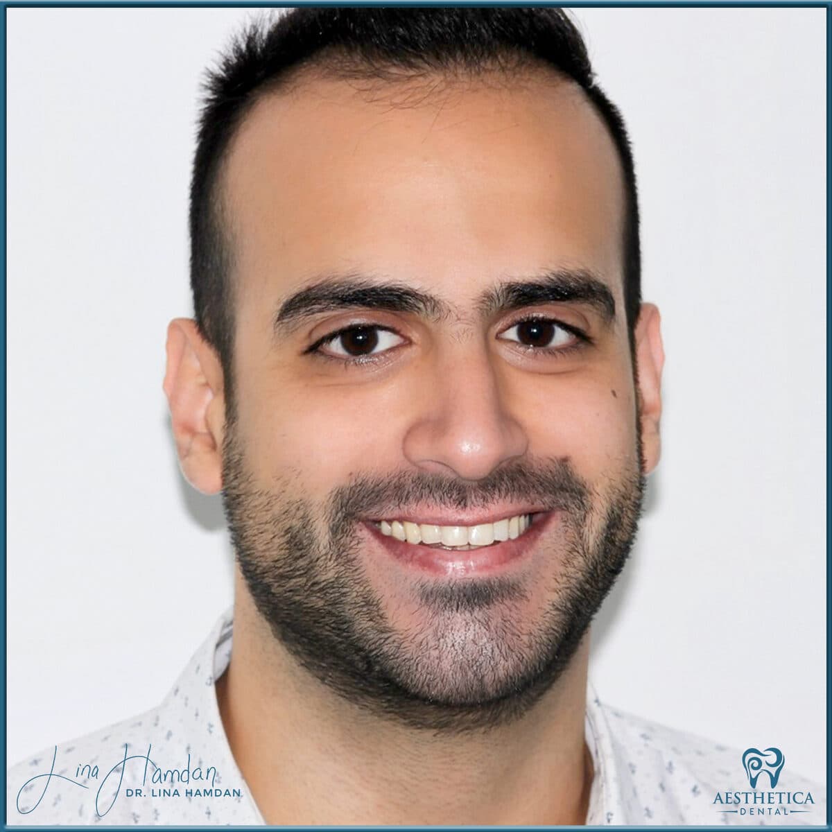 Composite bonding: anonymous case 75 from Aesthetica Dental Naperville