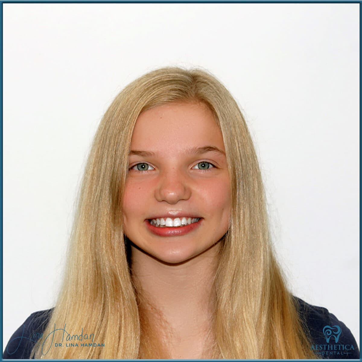 Composite bonding: anonymous case 76 from Aesthetica Dental Naperville