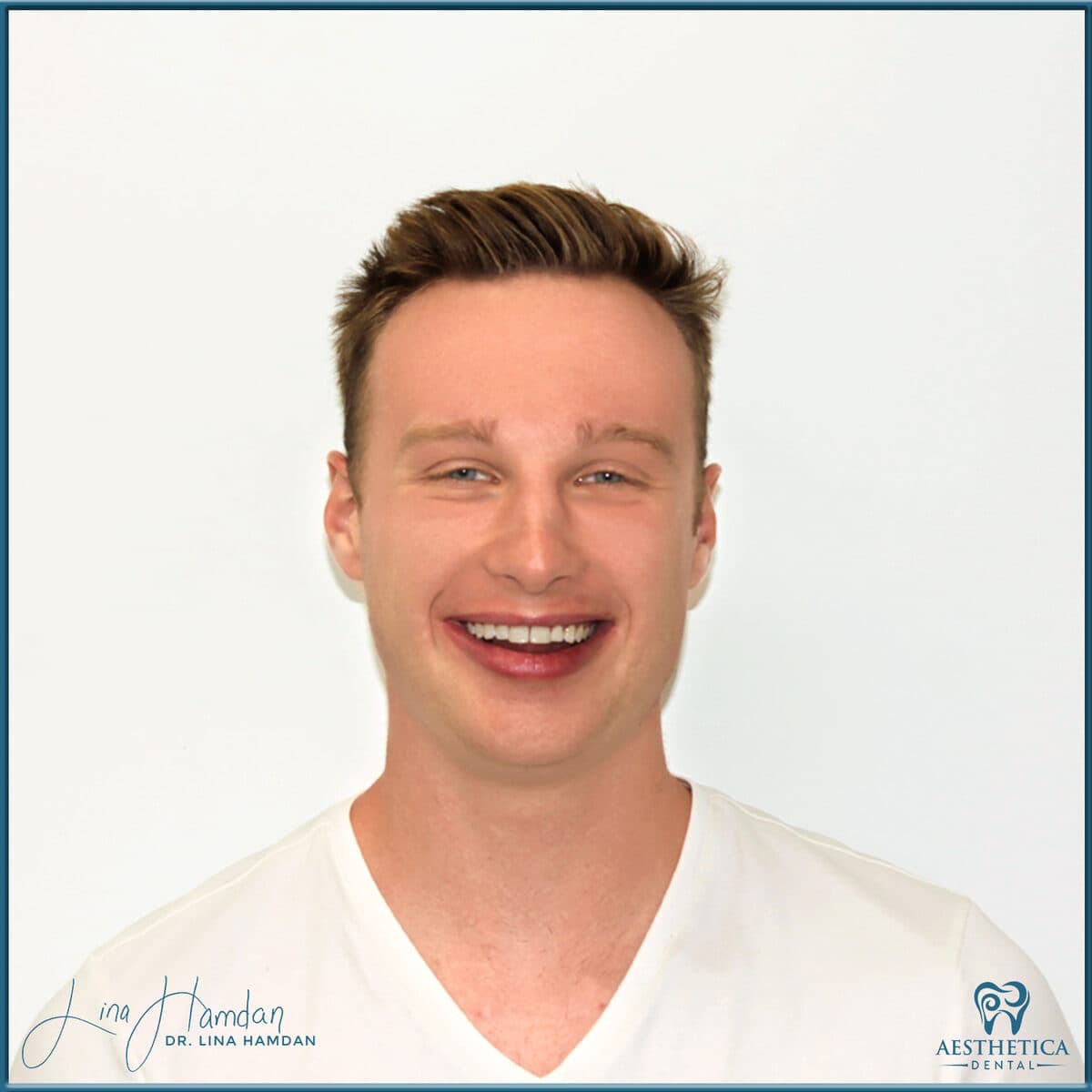 Composite bonding: anonymous case 81 from Aesthetica Dental Naperville