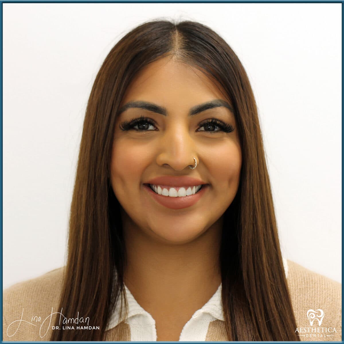 Composite bonding: anonymous case 85 from Aesthetica Dental Naperville