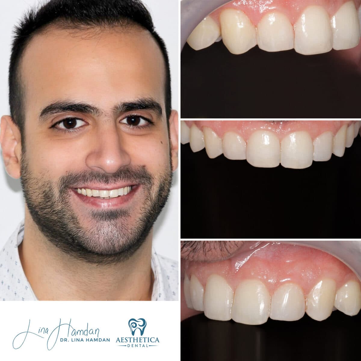Composite bonding: anonymous case 89 from Aesthetica Dental Naperville