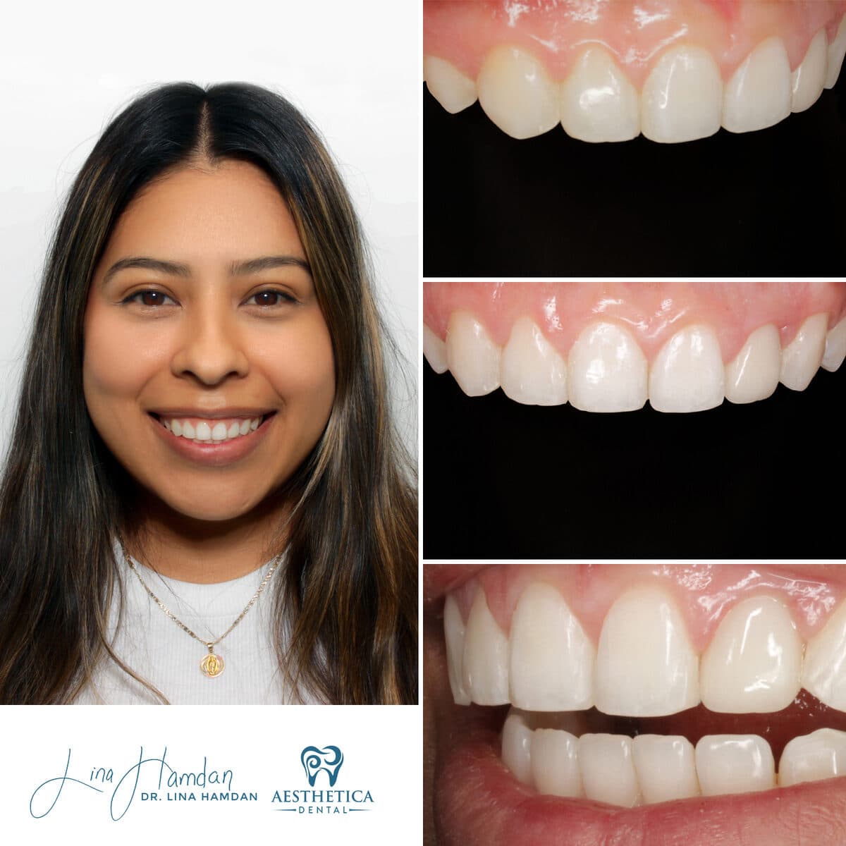 Composite bonding: anonymous case 90 from Aesthetica Dental Naperville