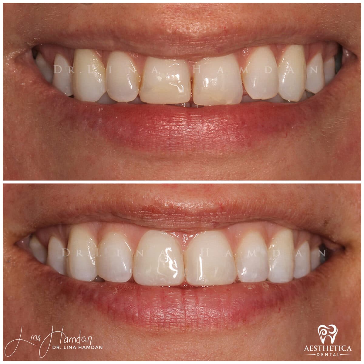 Composite bonding: anonymous case 95 from Aesthetica Dental Naperville