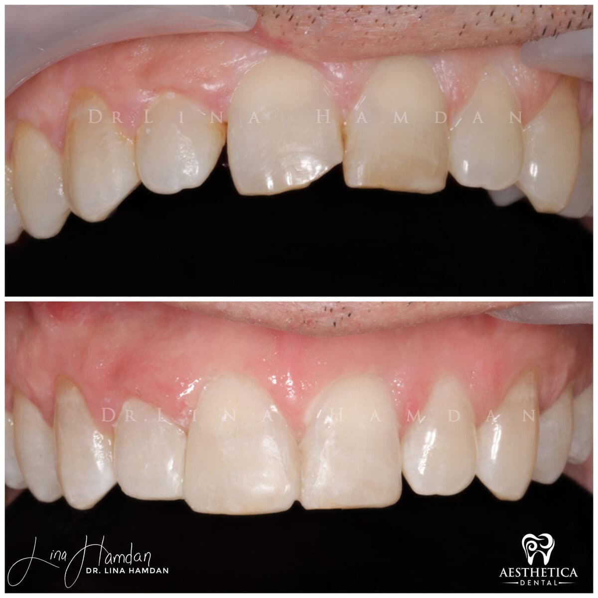 Composite bonding: anonymous case 97 from Aesthetica Dental Naperville