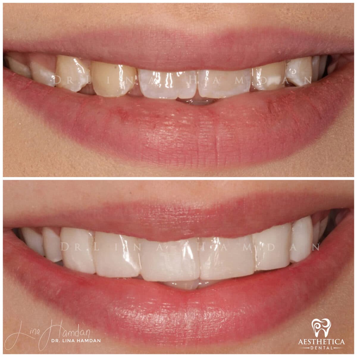 Composite bonding: anonymous case 98 from Aesthetica Dental Naperville